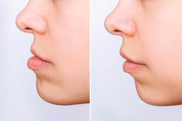 snow white glutathione injection SNOW WHITE GLUTATHIONE IV DRIP SET LIPOTOCIN 1200mg SET main image 1